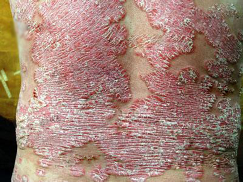 今年银屑病在我国的发病率高,银屑病发病率怎么样