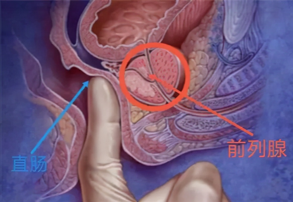 前列腺常规白细胞10-20严重吗,前列腺常规的检查方法