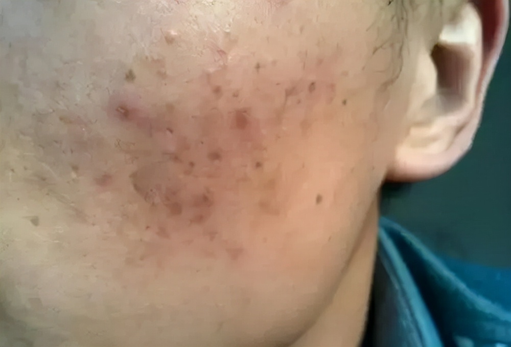 男生如何遮痘印,男生痘印怎么消除