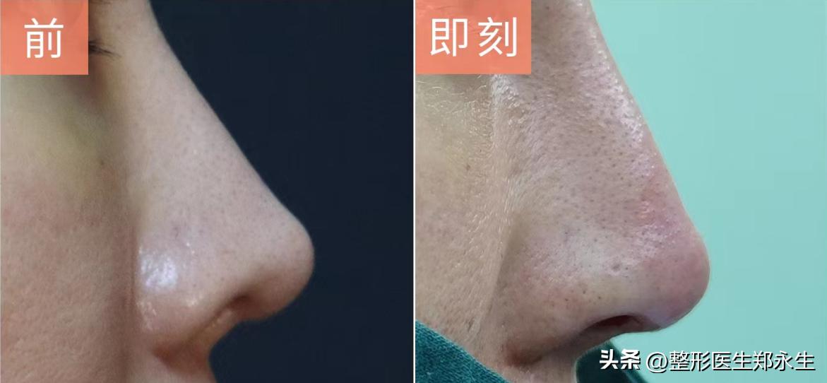 细节决定美丽，鼻尖改善对颜值的重要性，想要做鼻子要认真看