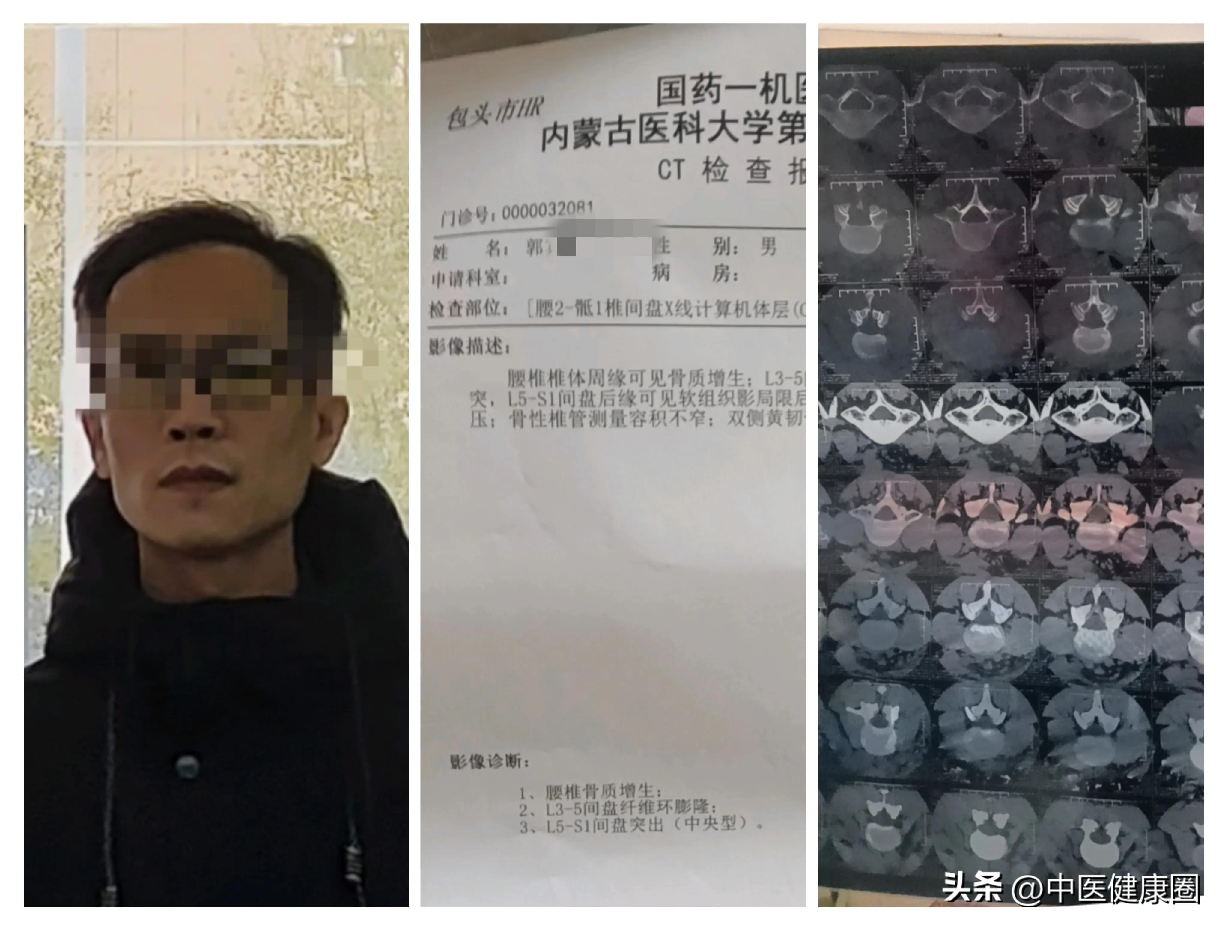 治腰突的二步十法,治腰突立竿见影的秘方