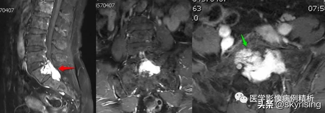 老年女性骶骨受侵椎管骶管内富血供占位影诊思维过程