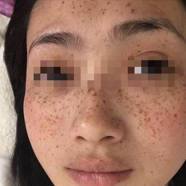 面部斑点小常识大全,面部斑点怎么消除中医