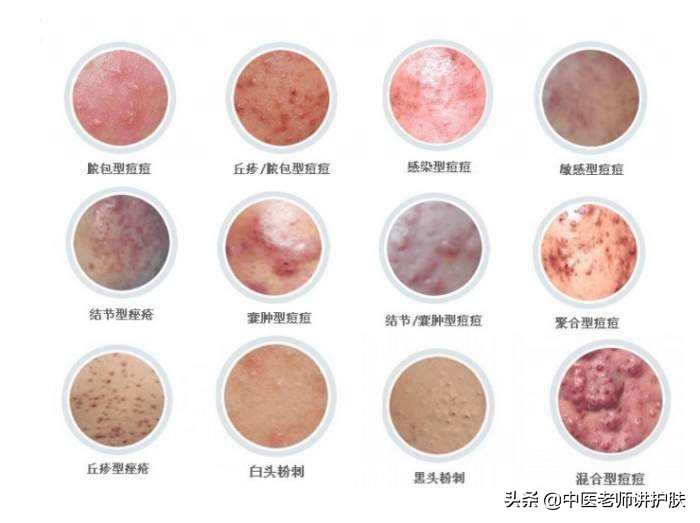 激素依赖性皮炎的发病机制,什么是激素依赖性皮炎怎么治疗