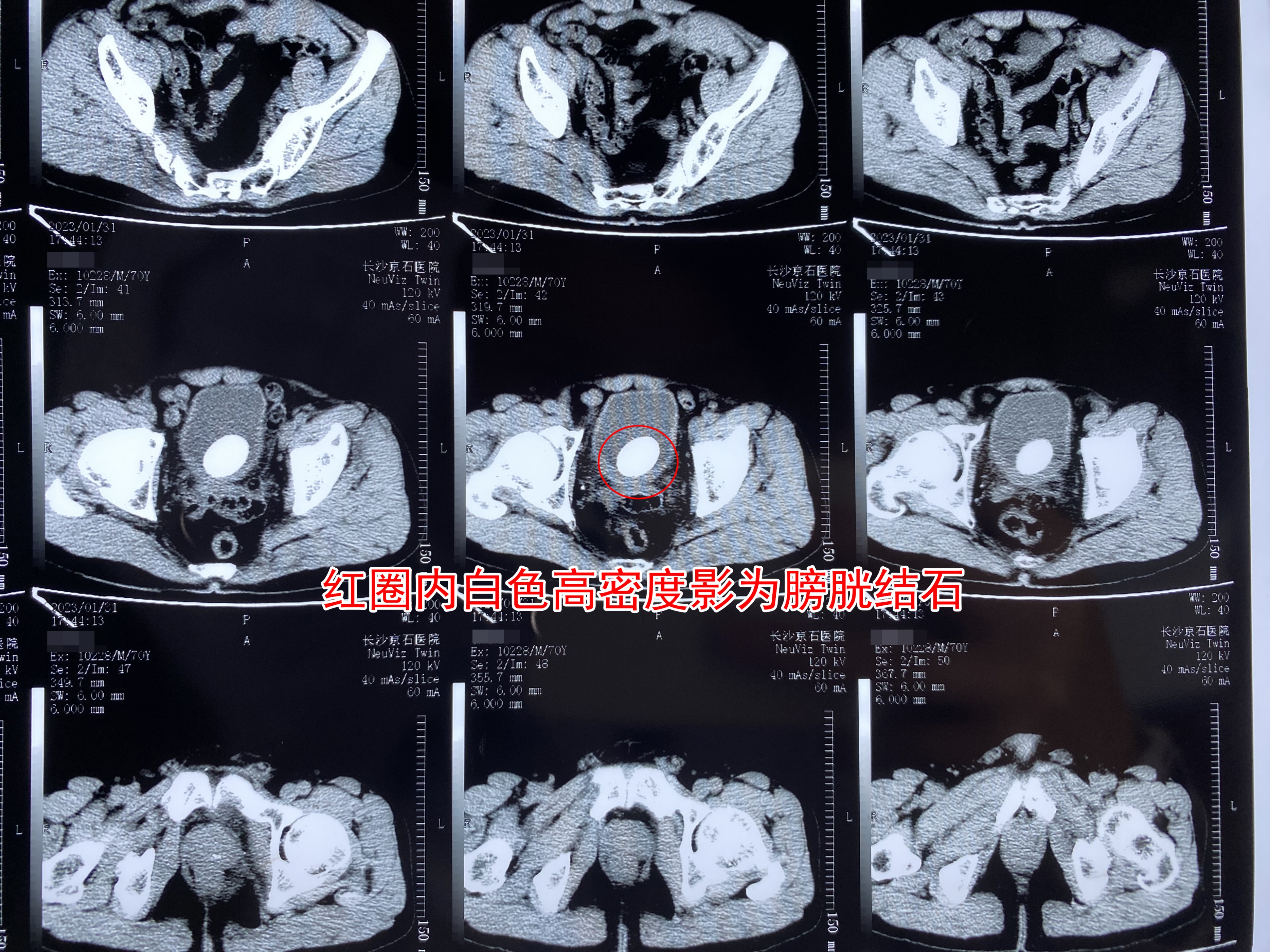 嗲嗲尿频大半年隐忍不治膀胱结石竟长成似“麻球”
