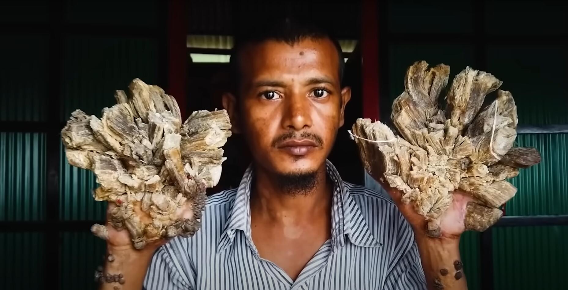 10个难以置信的人类，树皮人、外星人、拥有粗壮手臂的大力水手