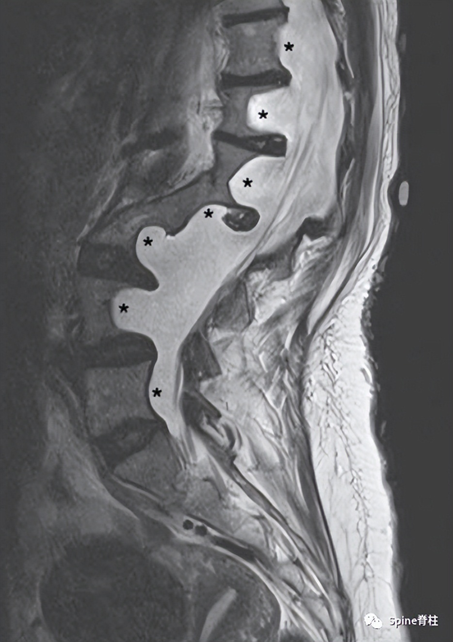 硬膜扩张,duralectasia