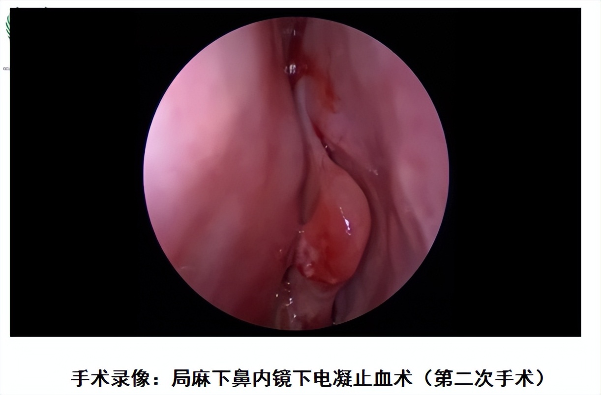 一次摔跤引发的灾难有哪些,一摔跤就流血不止是什么病