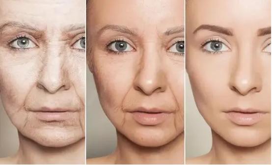 面部松弛下垂凹陷填充,鼻基底皮肤松弛怎么改善