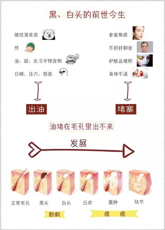 简单实用有效去黑头的方法,如何用简单的方法去黑头真实有效