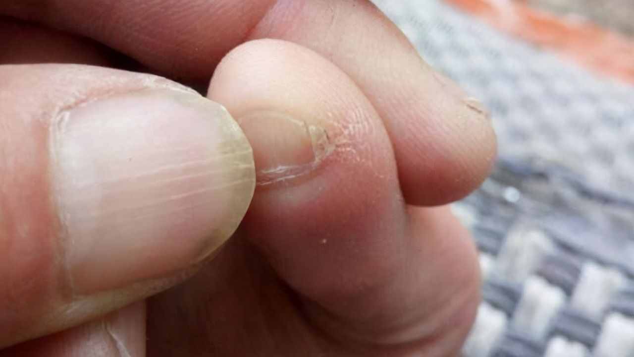 小脚趾甲分成两瓣的人怎么了,小脚趾甲长成两瓣