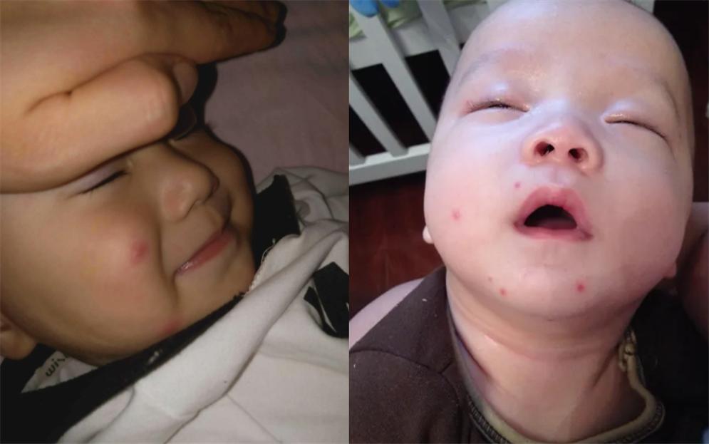 宝宝夏天很惹蚊子,宝宝被蚊子困扰