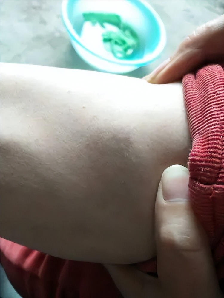 脖子和腋下总长“小肉粒”？可以用手揪吗？医生：与7种疾病有关