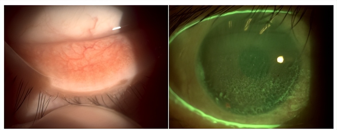 角膜接触镜验配案例图解,戴角膜塑形镜反复出现点染的原因