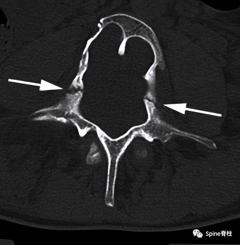 硬膜扩张,duralectasia