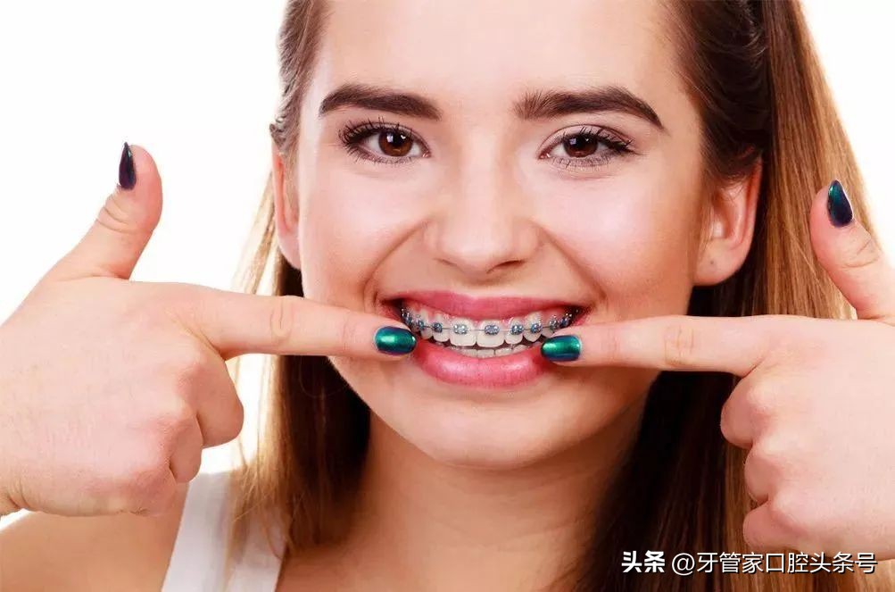 矫正牙齿戴牙套需要注意事项,矫正后戴保持器有什么讲究