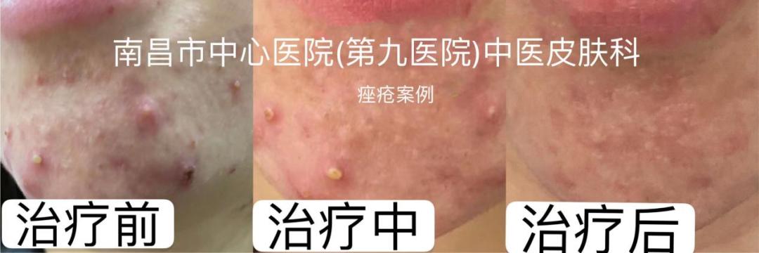 想拥有光滑无痘的脸，别再做这个动作了