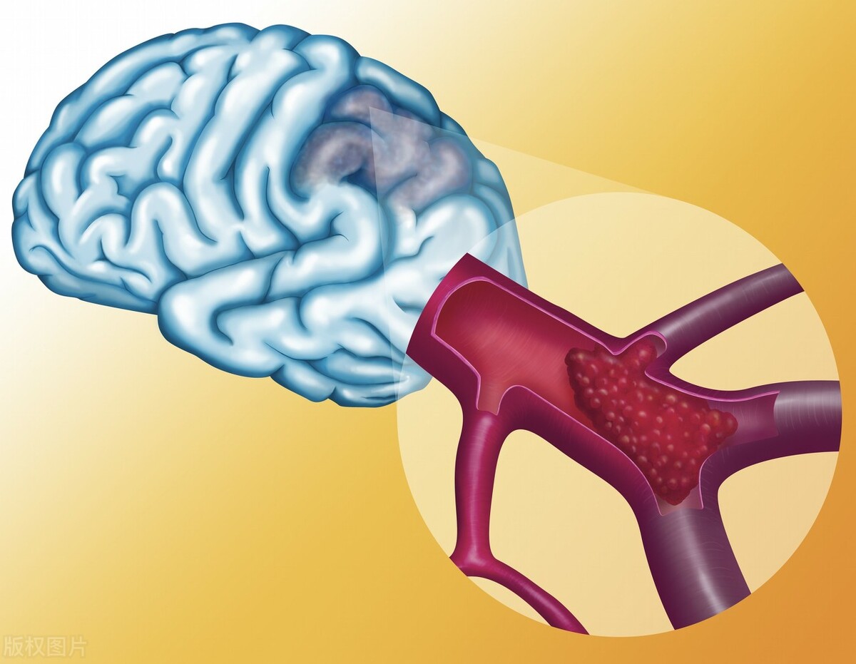 年轻人突发脑梗,为啥年轻人发生心梗脑梗越来越多
