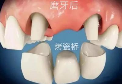 烤瓷牙什么情况要拆除,烤瓷牙崩瓷了要修复多少钱