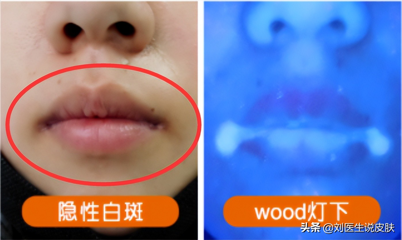 一篇文章总结：白癜风为什么边治疗边发展？分享最有效的控制方法