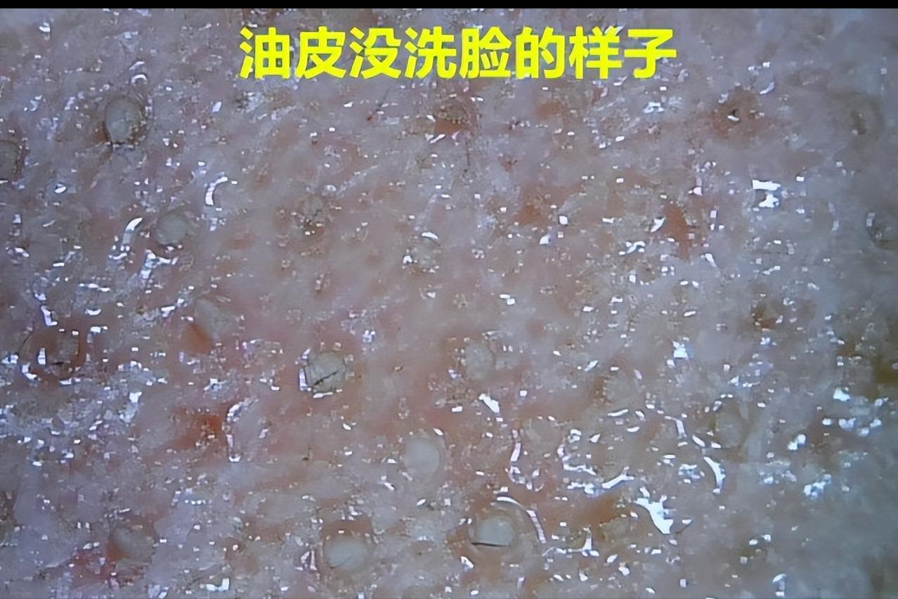 鼻子上有白白的小点可以挤吗,鼻子上黑黑的小点点怎么去除