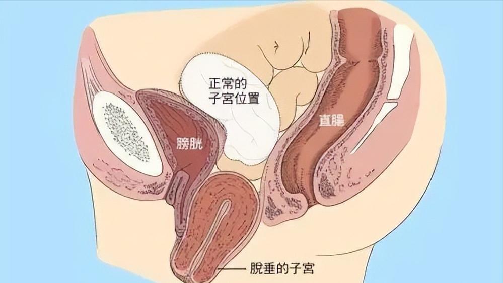 女性没了子宫之后和正常人有什么区别？身体的变化，让你无法忽视