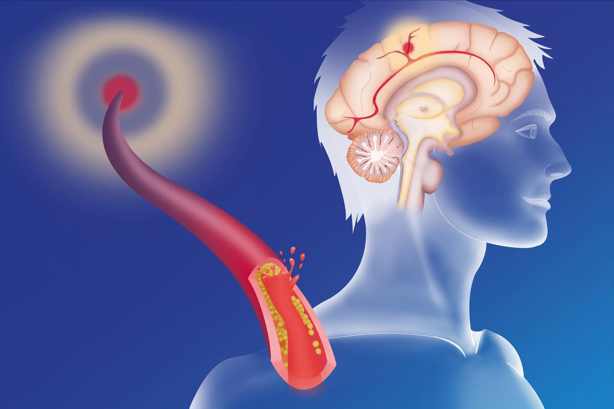 甲钴胺治疗腰椎间盘突出是神药吗 (甲钴胺片是治疗腰椎间盘突出吗)