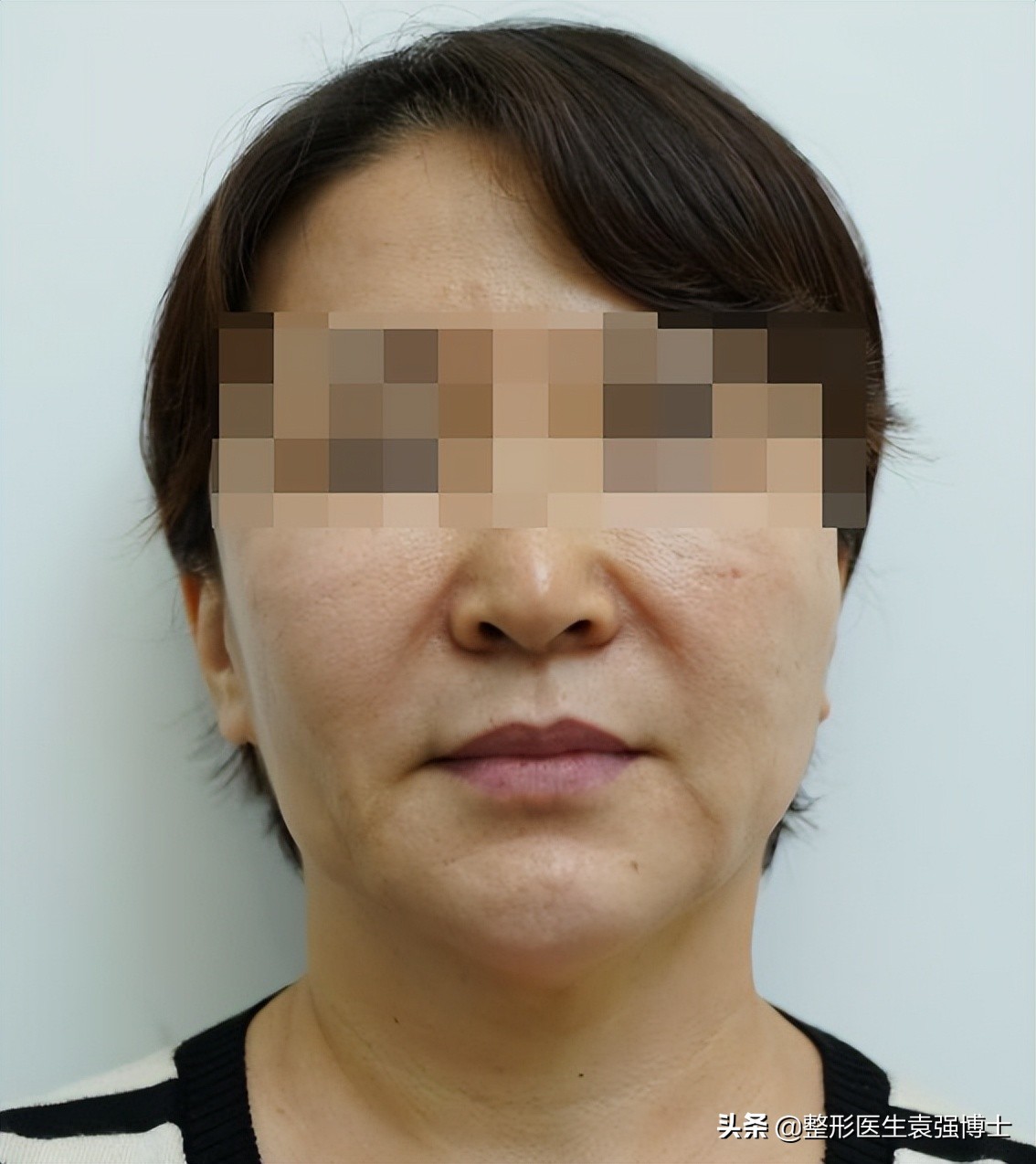 拉皮手术是额头切口还是耳前切口,拉皮手术耳前切