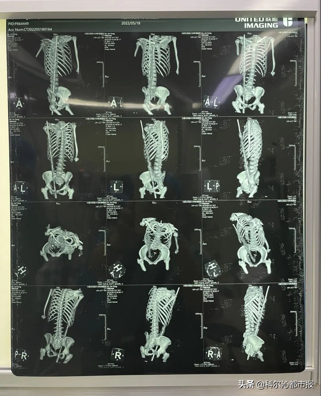 奇迹生还者完整视频,女子被钢筋穿体奇迹生还