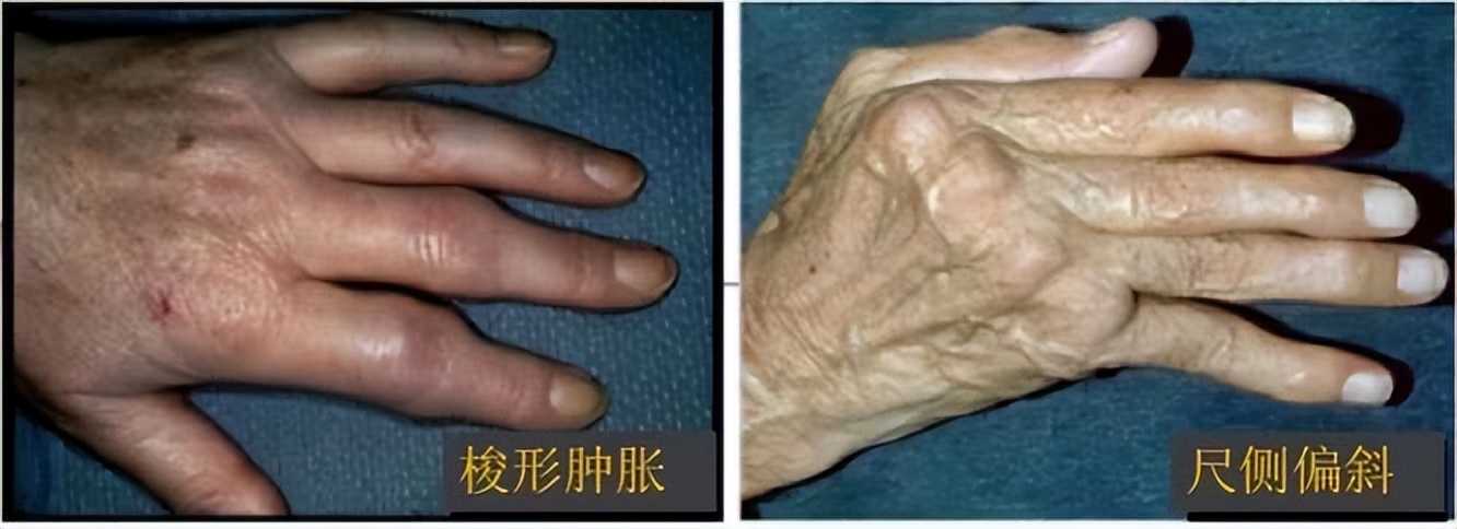 风湿免疫类疾病最怕什么,风湿免疫疾病如何预防