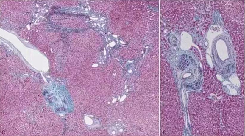 肝囊肿和肝占位影像学鉴别,杨永峰医生个人简历