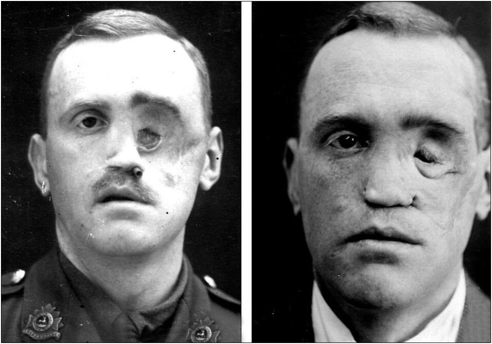 一空姐注射玻尿酸险丧命,空姐拍注射玻尿酸打进血管险丧命