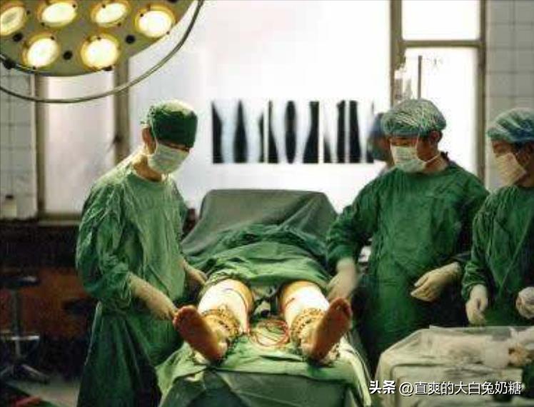 李亚诺断骨增高怎样了,断骨增高手术的李亚诺现状