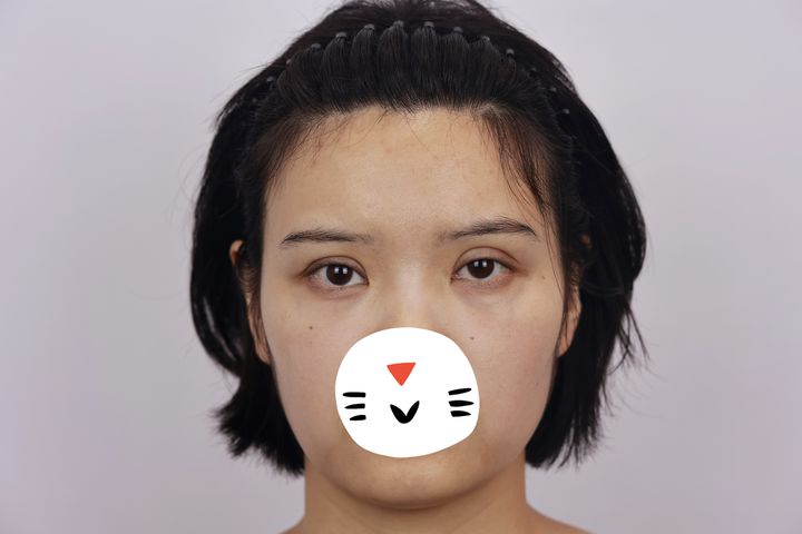 双眼皮术后大小眼是什么原因,双眼皮术后大小眼30天恢复图