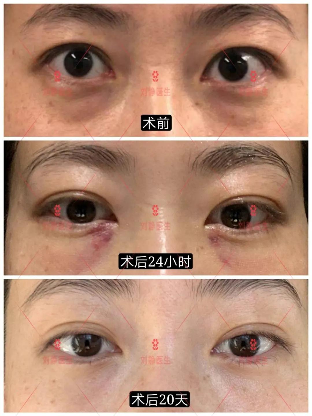 如何消除眼袋下的皱纹的方法,如何消除眼袋黑眼圈的按摩手法