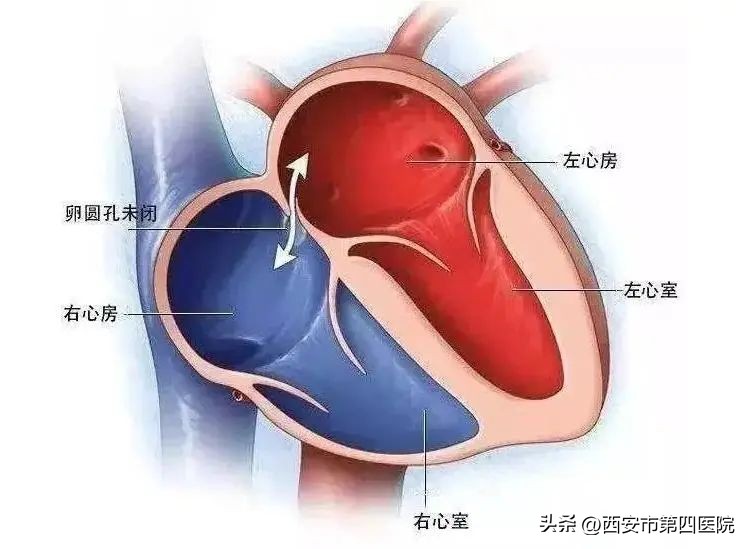 #健康中国行动2030#偏头痛30年原因竟是它?很多人心脏上都多了个小洞洞