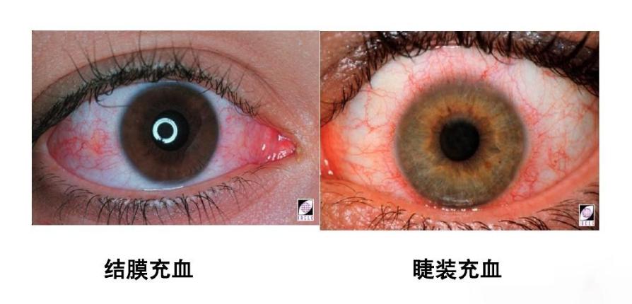 眼皮为什么会跳,为什么眼皮会跳动