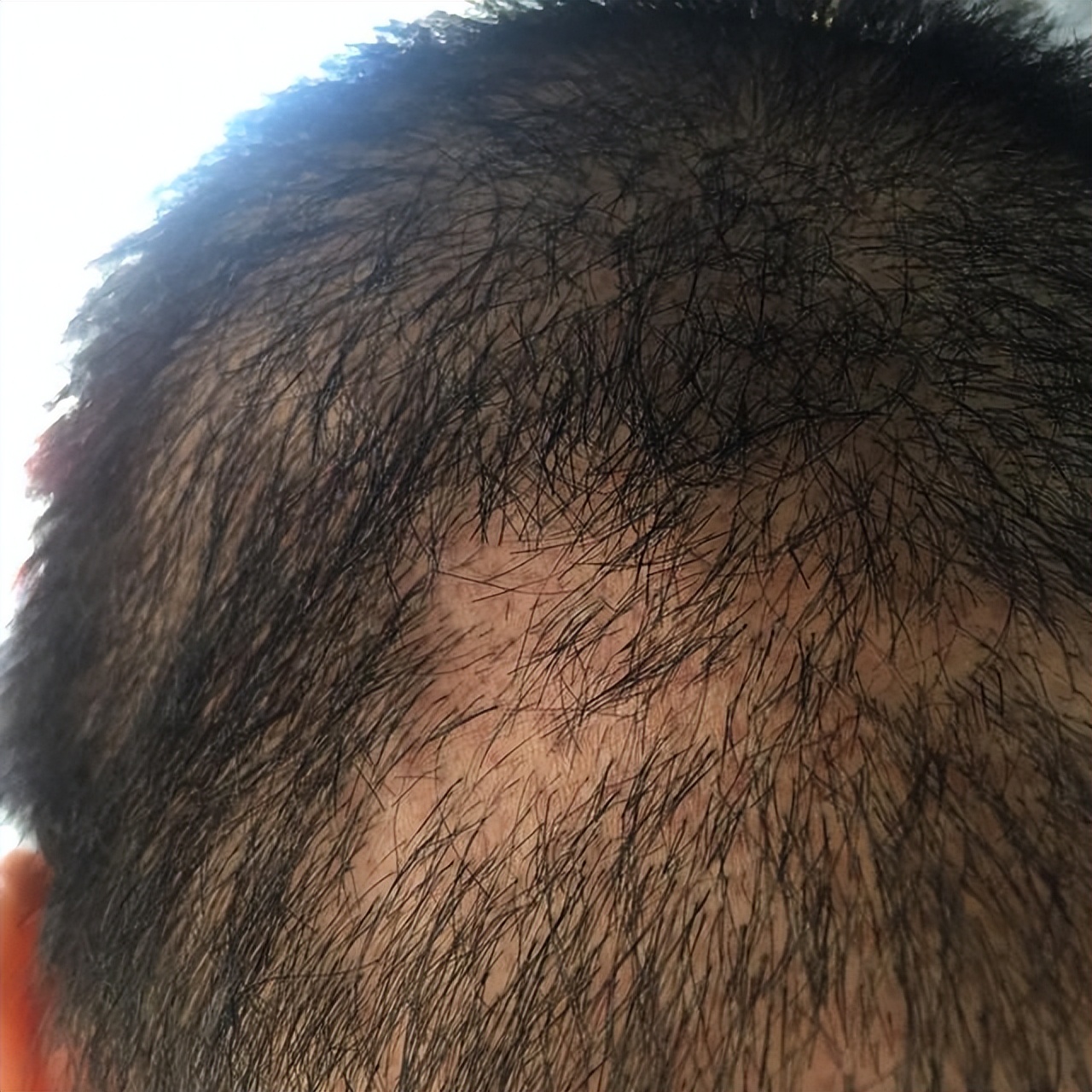 头皮上经常长疙瘩和脓包怎样治疗,头皮长疙瘩和脓包的常见原因