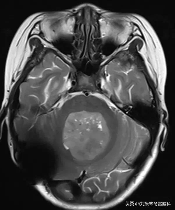 头痛恶心呕吐后缓解,小儿头痛呕吐是怎么回事
