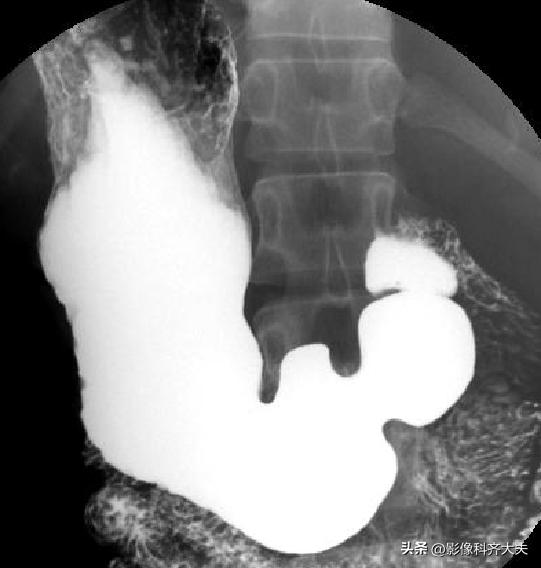 胃肠道造影超声解剖图,胃肠钡餐影像检查片子
