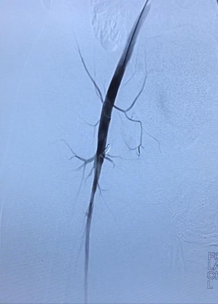 血管畸形伴大静脉瘤扩张,下肢动静脉畸形介入治疗