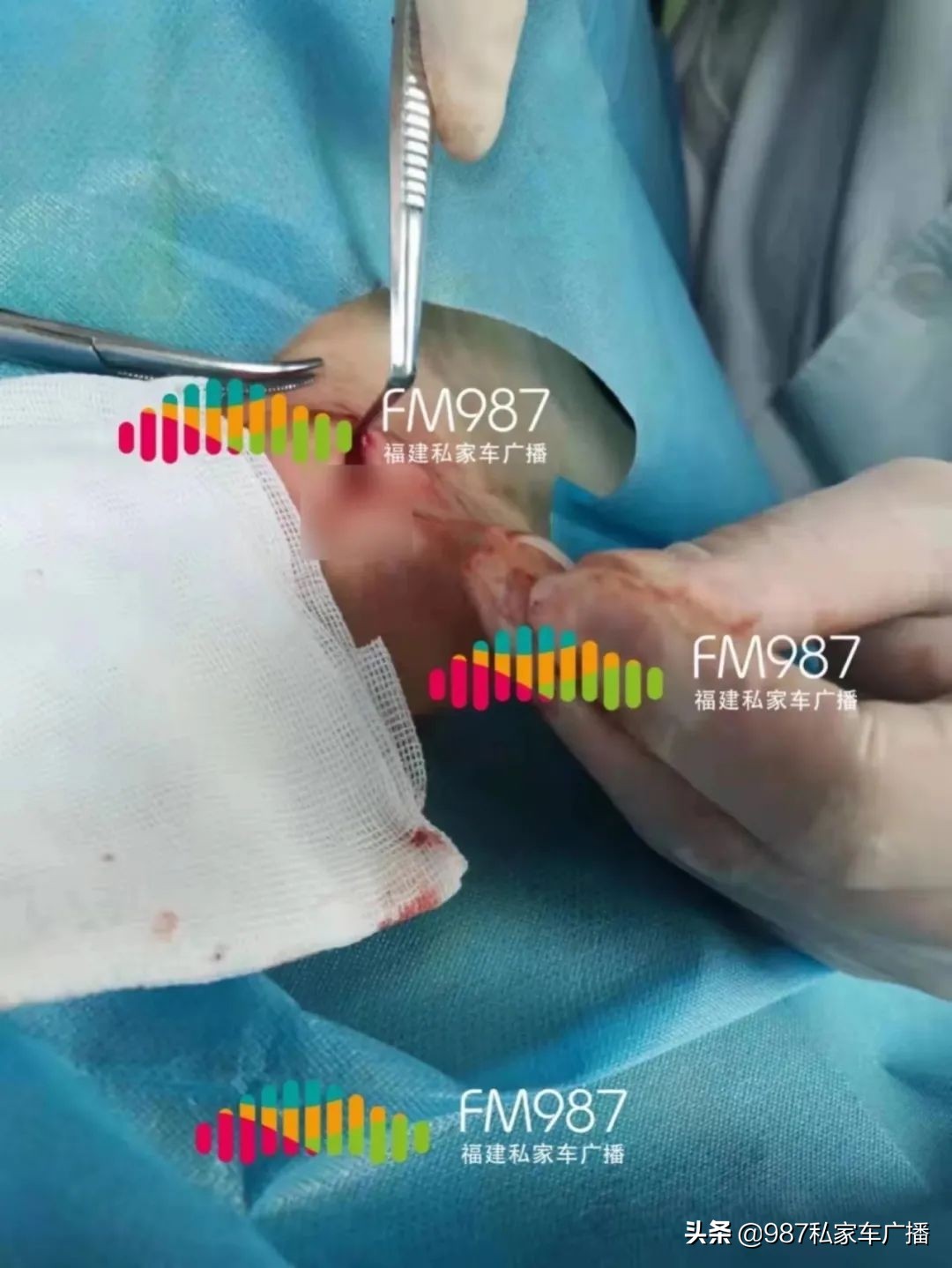 福州一女子体内取出大肿瘤,女子术后体内遗留3块纱布