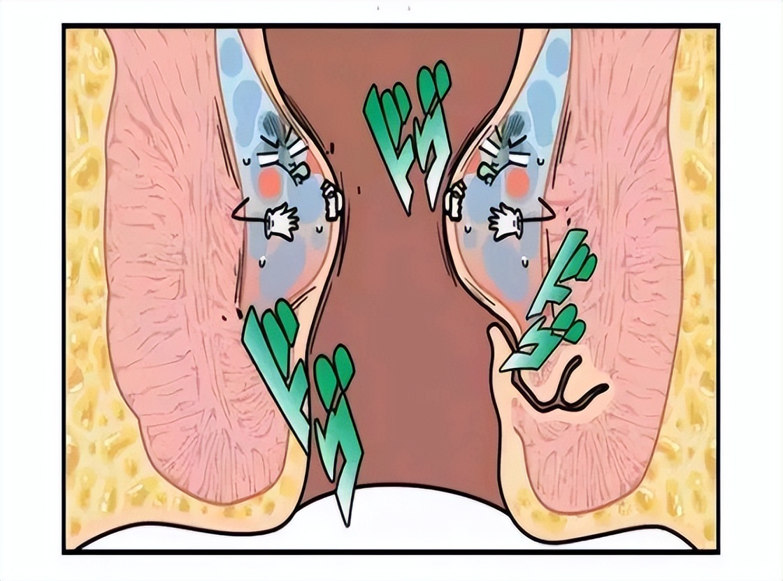 肛门瘙痒潮湿是什么原因怎么治疗,肛门周围潮湿又痒怎么治疗