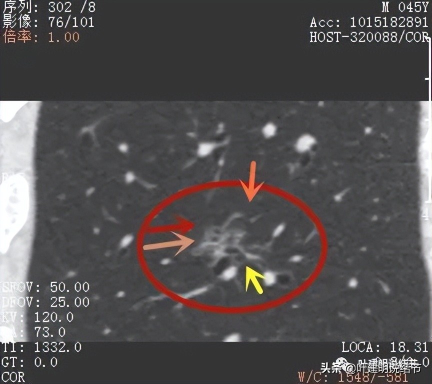 肺蜂窝状改变是肺癌吗,肺部陈旧灶与肿瘤怎么确诊