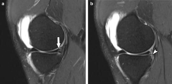 查半月板是拍片还是磁共振,半月板核磁共振影像诊断