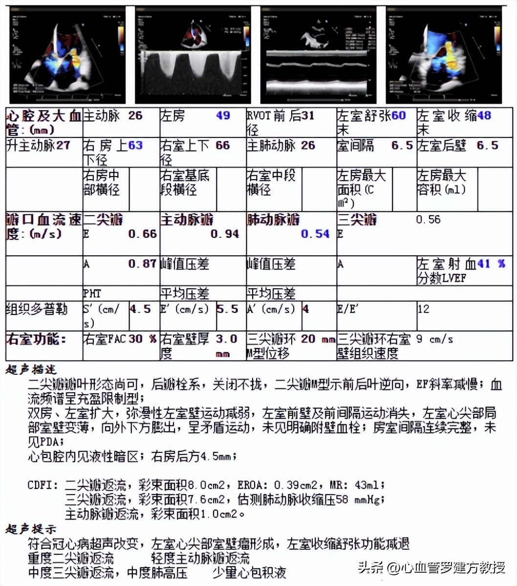 二尖瓣狭窄病例分享,二尖瓣病理生理及治疗方法