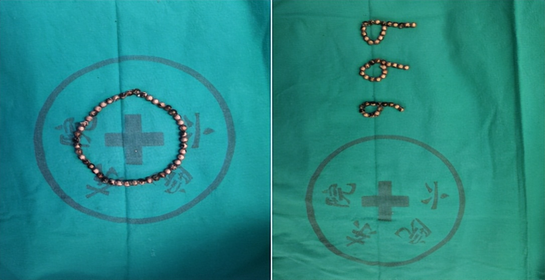 尿道异物怎么消除,如果尿道有异物应该怎么办