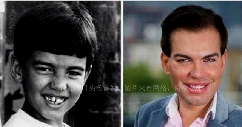 “真人肯尼”痴迷整容。多年后，最终将自己整成了女人