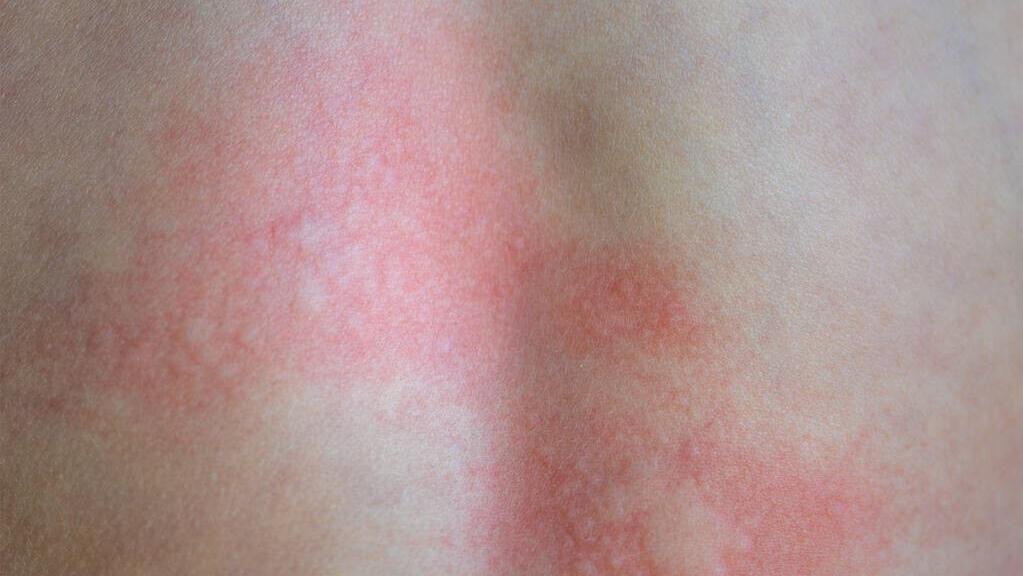 麻疹出不透的危害,麻疹和荨麻疹有什么危害