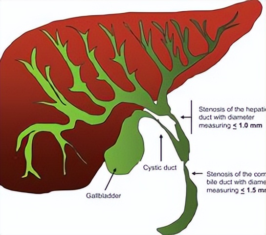 科普不可忽视的胆囊结石,胆管结石科普视频